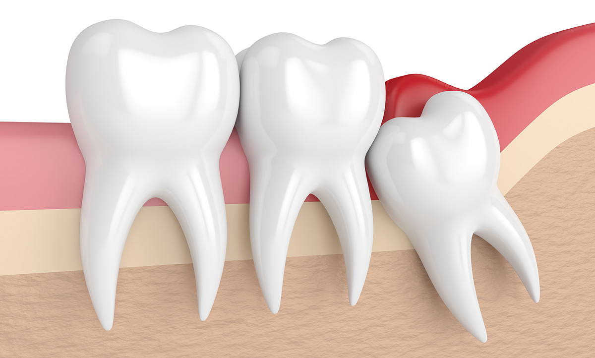 Extraction dent de sagesse  Clinique Dentaire Newport à Pantin