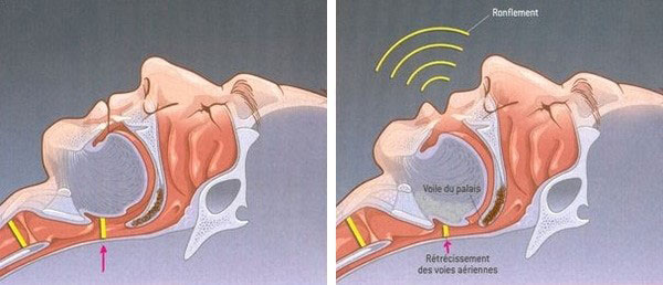 image-schema-solea-sleep-ronflement-dentiste-st-eustache